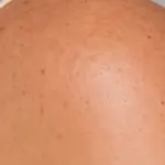 lichaamshuid
